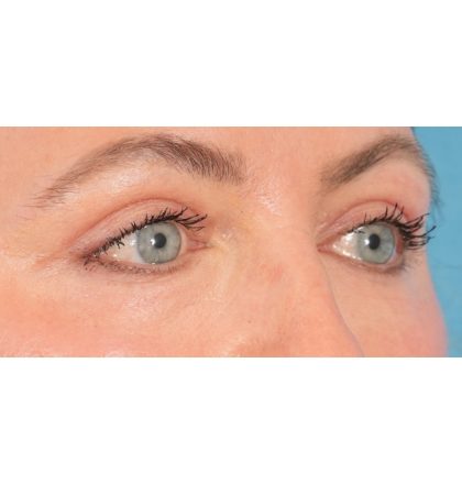 Upper Blepharoplasty Before & After Patient #2394