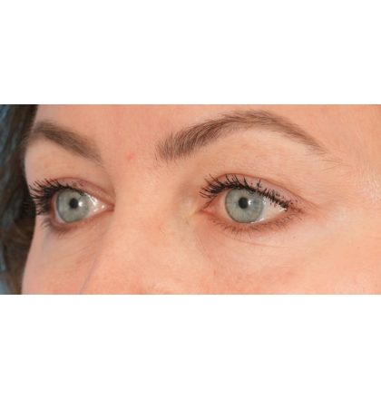 Upper Blepharoplasty Before & After Patient #2394