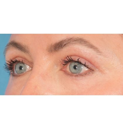 Upper Blepharoplasty Before & After Patient #2394