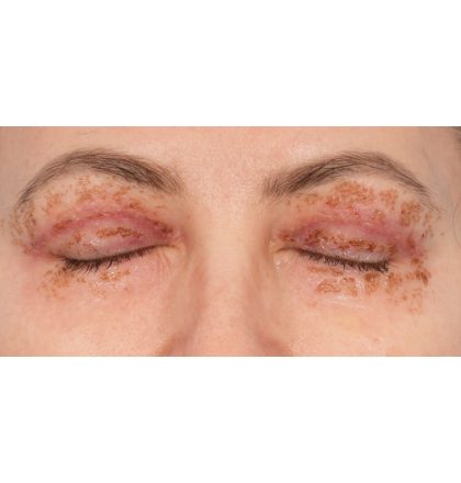 Upper Blepharoplasty Before & After Patient #2394