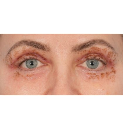 Upper Blepharoplasty Before & After Patient #2394