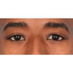 Upper Blepharoplasty Before & After Patient #2352