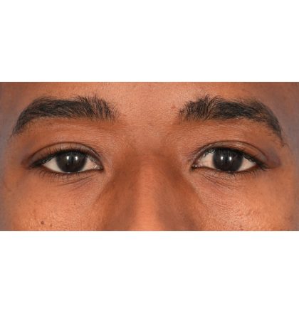 Upper Blepharoplasty Before & After Patient #2352