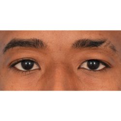 Upper Blepharoplasty Before & After Patient #2352