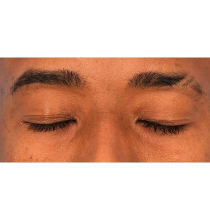 Upper Blepharoplasty Before & After Patient #2352