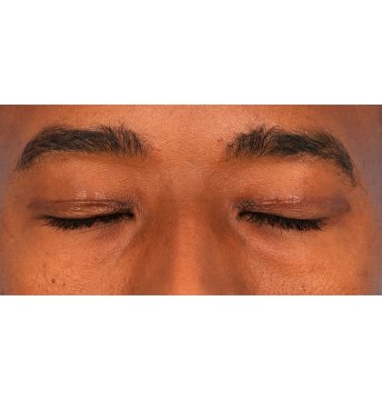 Upper Blepharoplasty Before & After Patient #2352