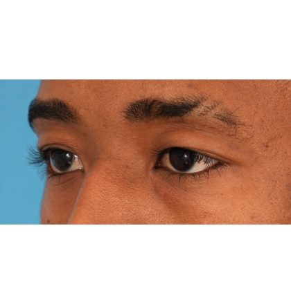 Upper Blepharoplasty Before & After Patient #2352