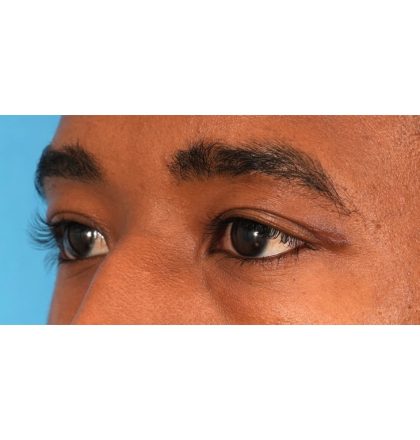 Upper Blepharoplasty Before & After Patient #2352