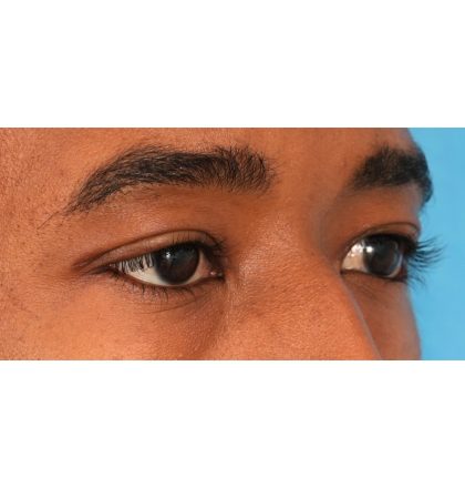 Upper Blepharoplasty Before & After Patient #2352