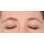 Brow Contour Before & After Patient #2534