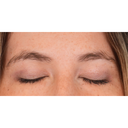 Brow Contour Before & After Patient #2534