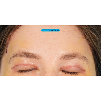 Brow Contour Before & After Patient #2534