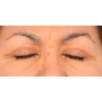 Upper Blepharoplasty Before & After Patient #2496