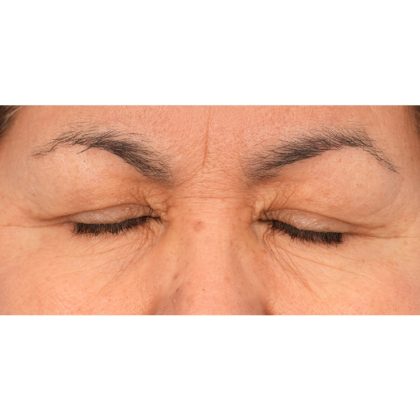 Upper Blepharoplasty Before & After Patient #2496