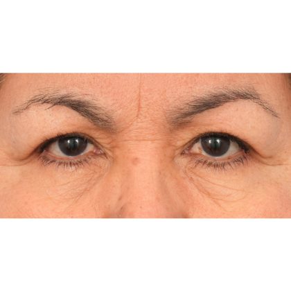 Upper Blepharoplasty Before & After Patient #2496