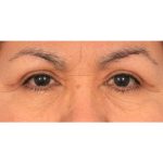 Upper Blepharoplasty Before & After Patient #2496