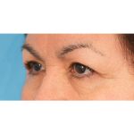 Upper Blepharoplasty Before & After Patient #2496