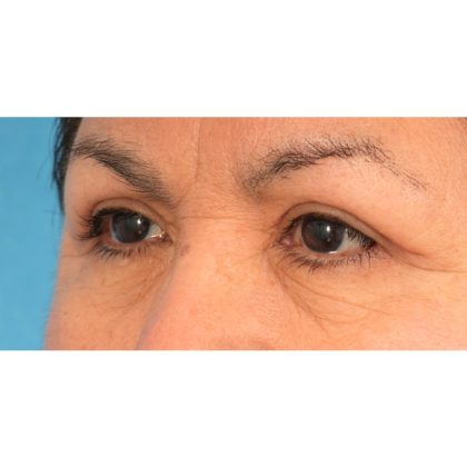 Upper Blepharoplasty Before & After Patient #2496