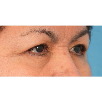 Upper Blepharoplasty Before & After Patient #2496