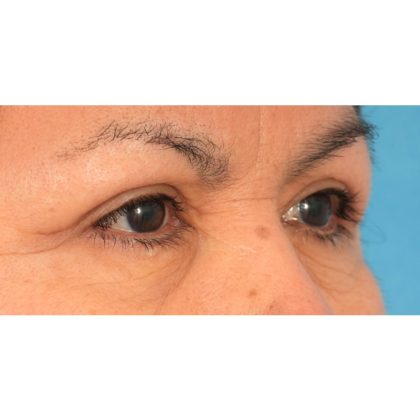 Upper Blepharoplasty Before & After Patient #2496