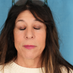 Lower Blepharoplasty Before & After Patient #2577