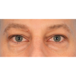 Lower Blepharoplasty Before & After Patient #2572