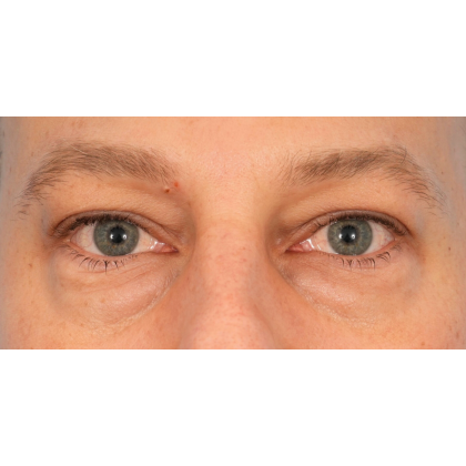 Lower Blepharoplasty Before & After Patient #2572