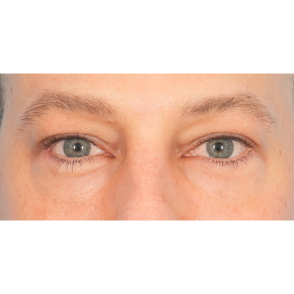 Lower Blepharoplasty Before & After Patient #2572