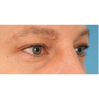 Lower Blepharoplasty Before & After Patient #2572