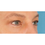 Lower Blepharoplasty Before & After Patient #2572