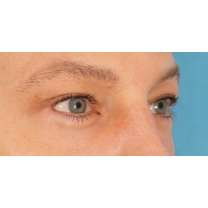 Lower Blepharoplasty Before & After Patient #2572