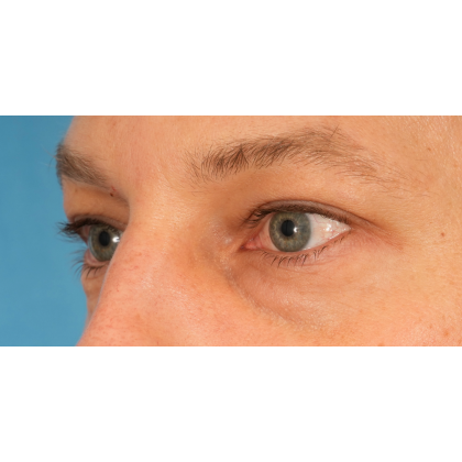 Lower Blepharoplasty Before & After Patient #2572