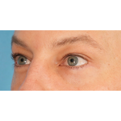 Lower Blepharoplasty Before & After Patient #2572