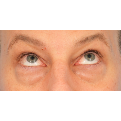 Lower Blepharoplasty Before & After Patient #2572