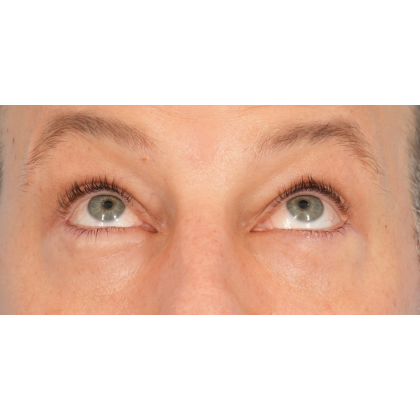 Lower Blepharoplasty Before & After Patient #2572