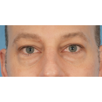 Lower Blepharoplasty Before & After Patient #2572