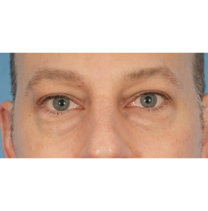 Lower Blepharoplasty Before & After Patient #2572