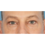 Lower Blepharoplasty Before & After Patient #2572