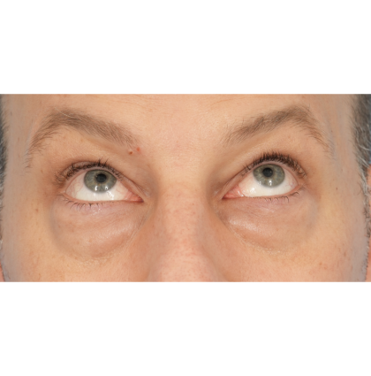 Lower Blepharoplasty Before & After Patient #2572