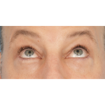 Lower Blepharoplasty Before & After Patient #2572