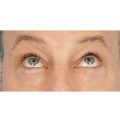 Lower Blepharoplasty Before & After Patient #2572