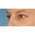 Lower Blepharoplasty Before & After Patient #2572