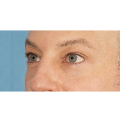 Lower Blepharoplasty Before & After Patient #2572