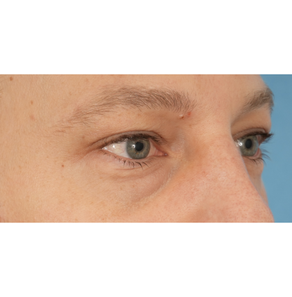 Lower Blepharoplasty Before & After Patient #2572