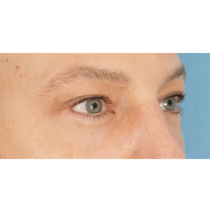 Lower Blepharoplasty Before & After Patient #2572