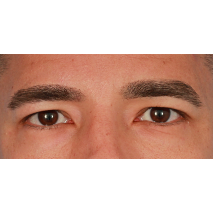 Upper Blepharoplasty Before & After Patient #2645