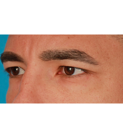 Upper Blepharoplasty Before & After Patient #2645