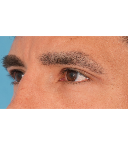 Upper Blepharoplasty Before & After Patient #2645