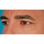 Upper Blepharoplasty Before & After Patient #2645