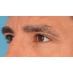 Upper Blepharoplasty Before & After Patient #2645